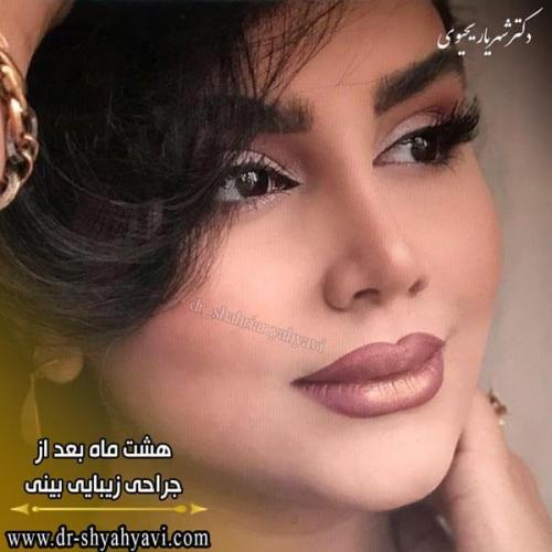 جراحی بینی 217