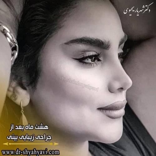 جراحی بینی 218