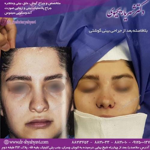 جراحی بینی 221