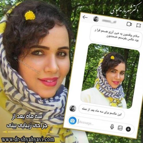 جراحی بینی 222