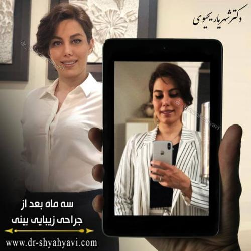 جراحی بینی 224