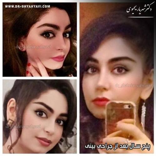 جراحی بینی 228