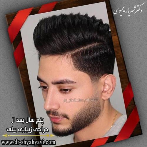 جراحی بینی 235