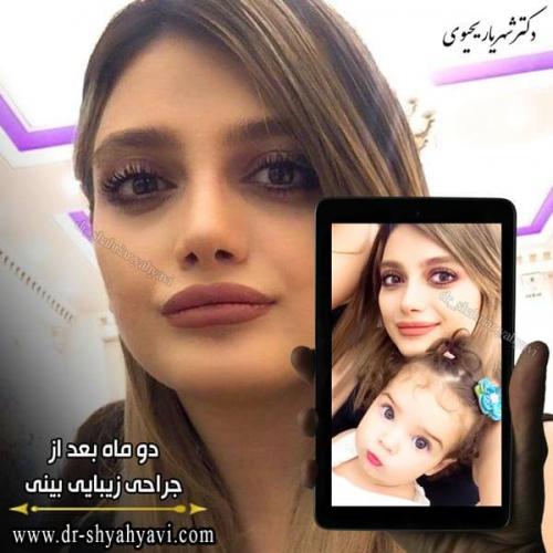 جراحی بینی 236