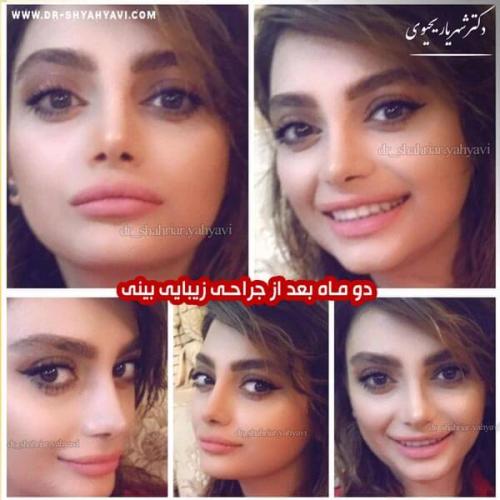 جراحی بینی 237