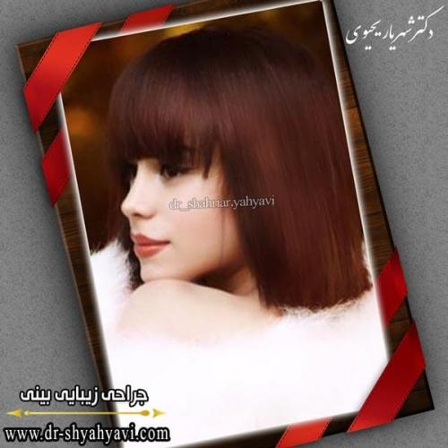 جراحی بینی 239