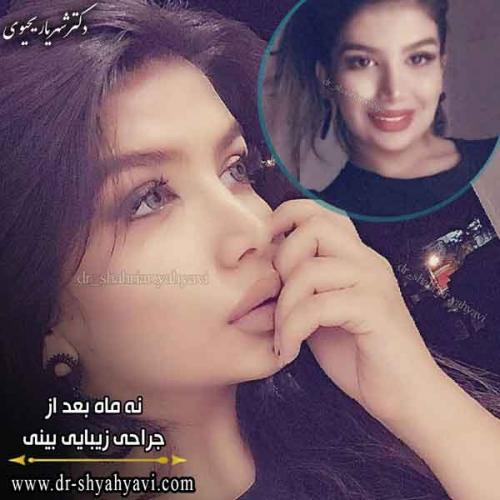 جراحی بینی 240