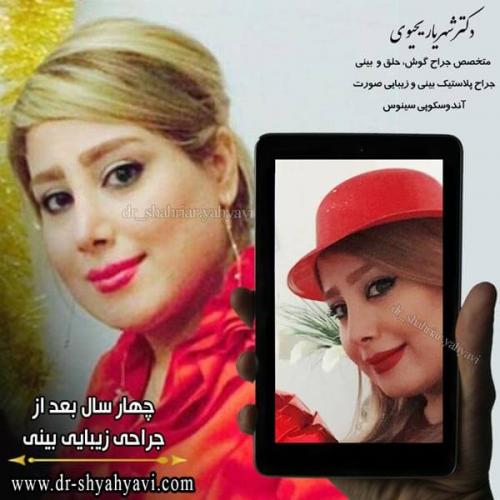 جراحی بینی 242