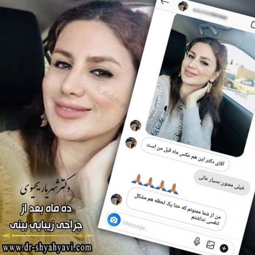 جراحی بینی 245