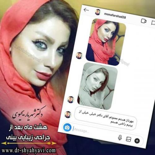 جراحی بینی 248