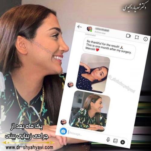 جراحی بینی 251