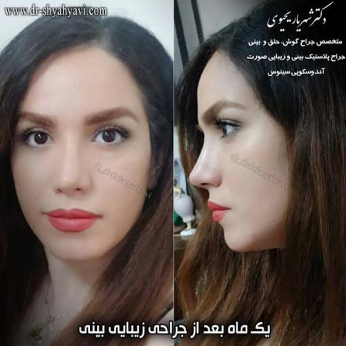 جراحی بینی 252