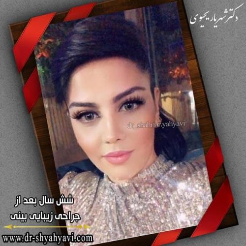 جراحی بینی 256