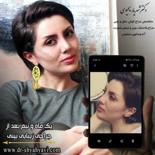 جراحی بینی 258