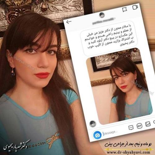 جراحی بینی 262