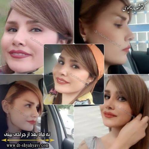 جراحی بینی 267