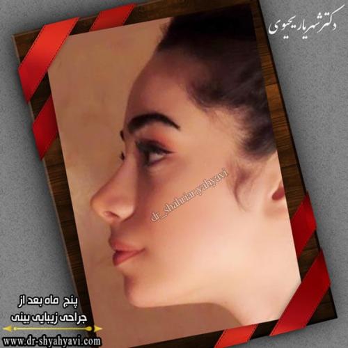 جراحی بینی 269