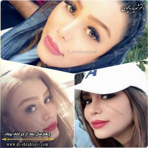 جراحی بینی 270