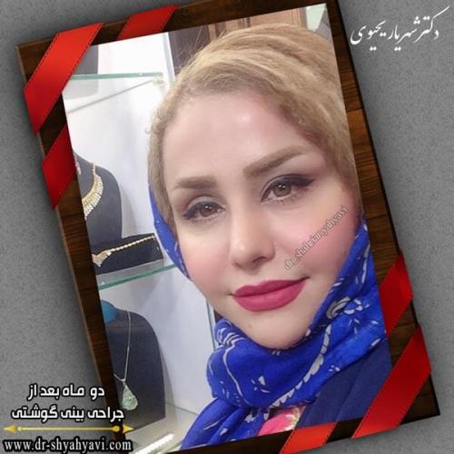 جراحی بینی 272