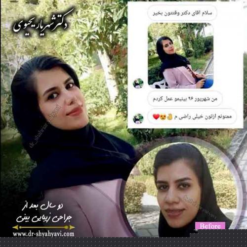 جراحی بینی 303