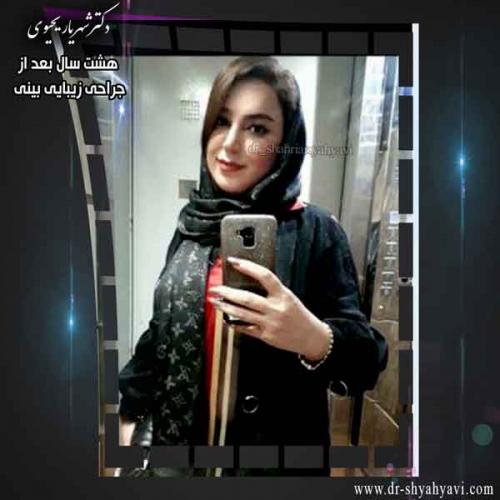 جراحی بینی 304