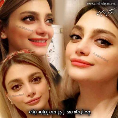 جراحی بینی 305