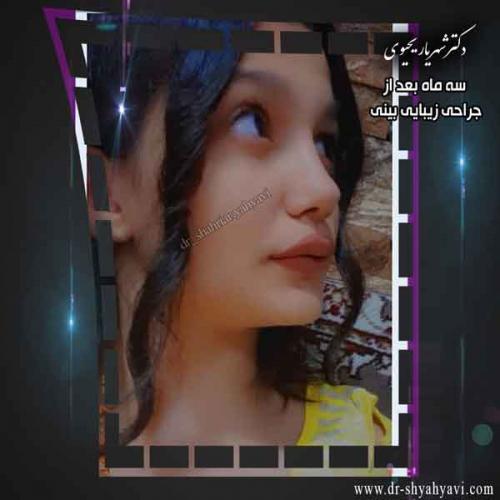 جراحی بینی 306