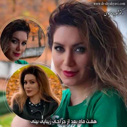 جراحی بینی 307