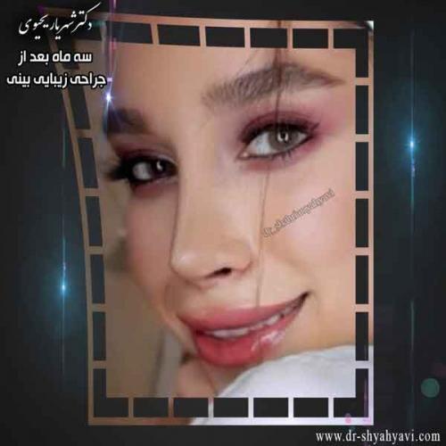 جراحی بینی 308