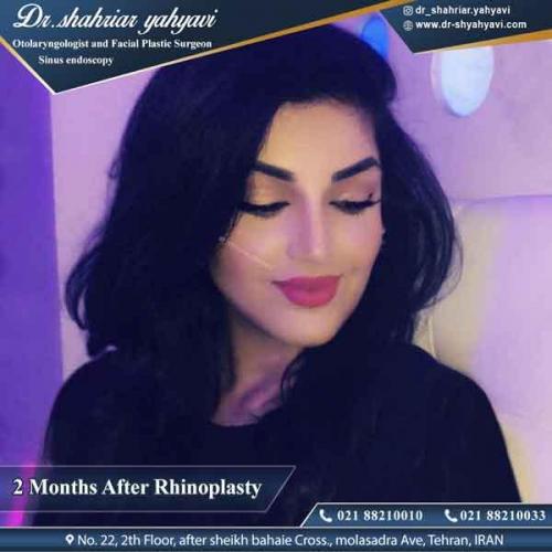 جراحی بینی 315