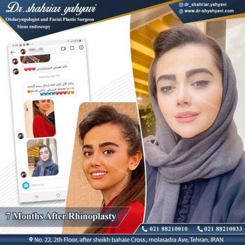 جراحی بینی 316