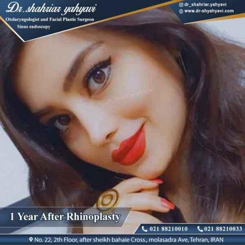 جراحی بینی 318