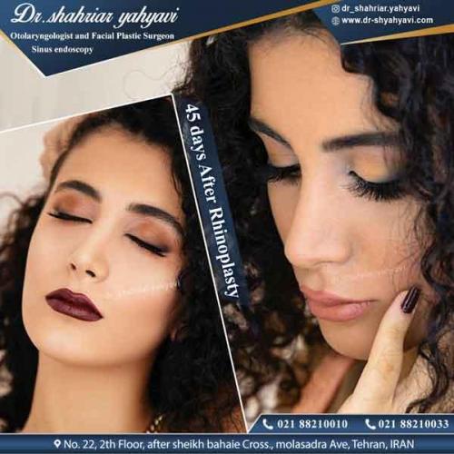 جراحی بینی 319