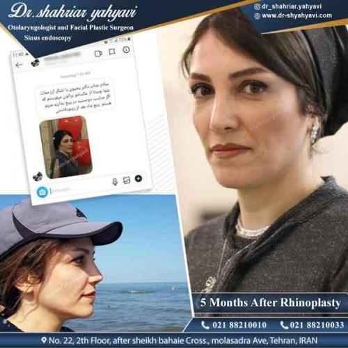 جراحی بینی 321