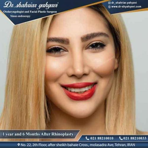 جراحی بینی 322