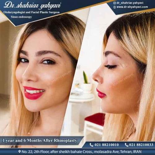 جراحی بینی 323