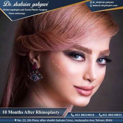 جراحی بینی 325