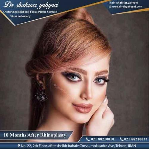 جراحی بینی 326