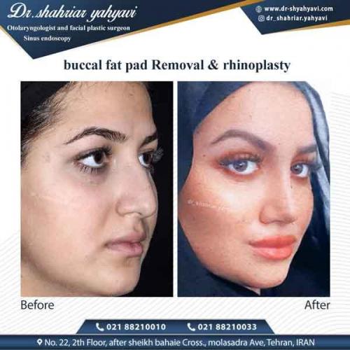 جراحی بینی 332