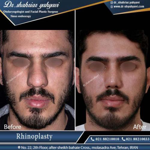 جراحی بینی 332 (1)