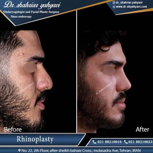 جراحی بینی 333