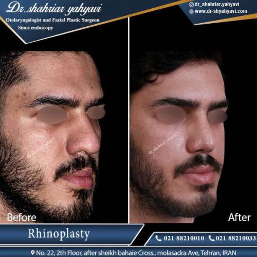 جراحی بینی 334