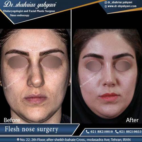 جراحی بینی 335