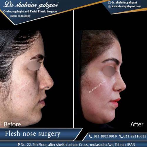 جراحی بینی 336