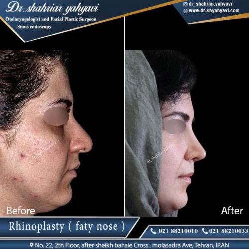 جراحی بینی 337
