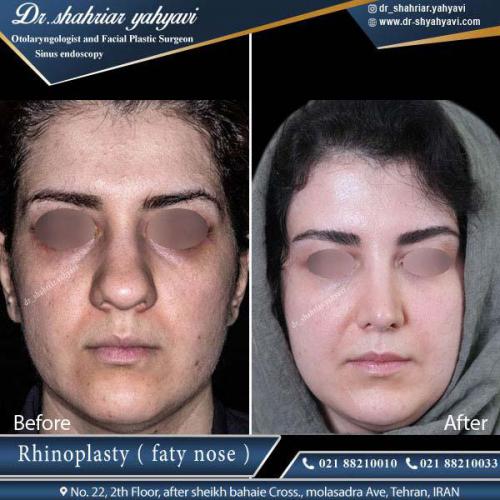 جراحی بینی 338