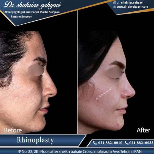 جراحی بینی 340
