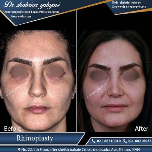 جراحی بینی 341