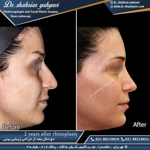 جراحی بینی 342