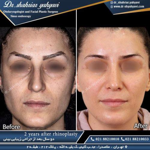 جراحی بینی 343